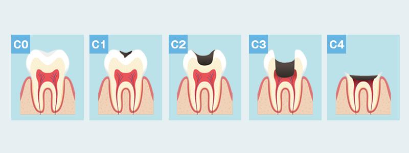 むし歯の進行画像CO~C4まで