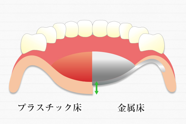 金属床とプラスチック床の違和感比較