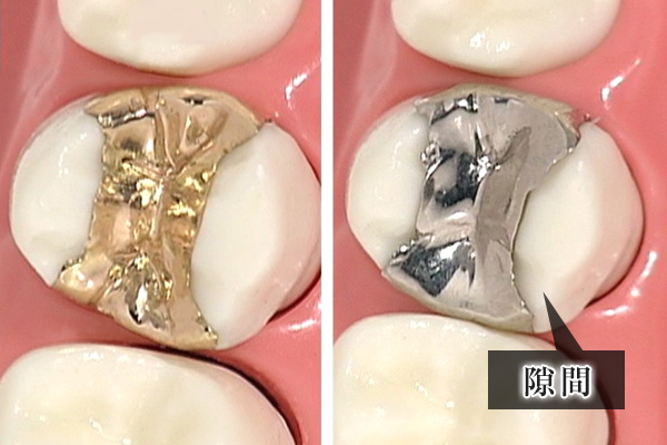 ゴールドと銀歯の比較