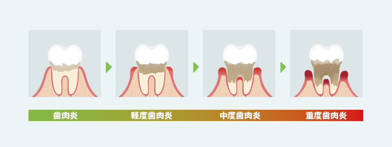 歯周病の進行