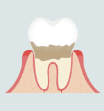 中度歯周病